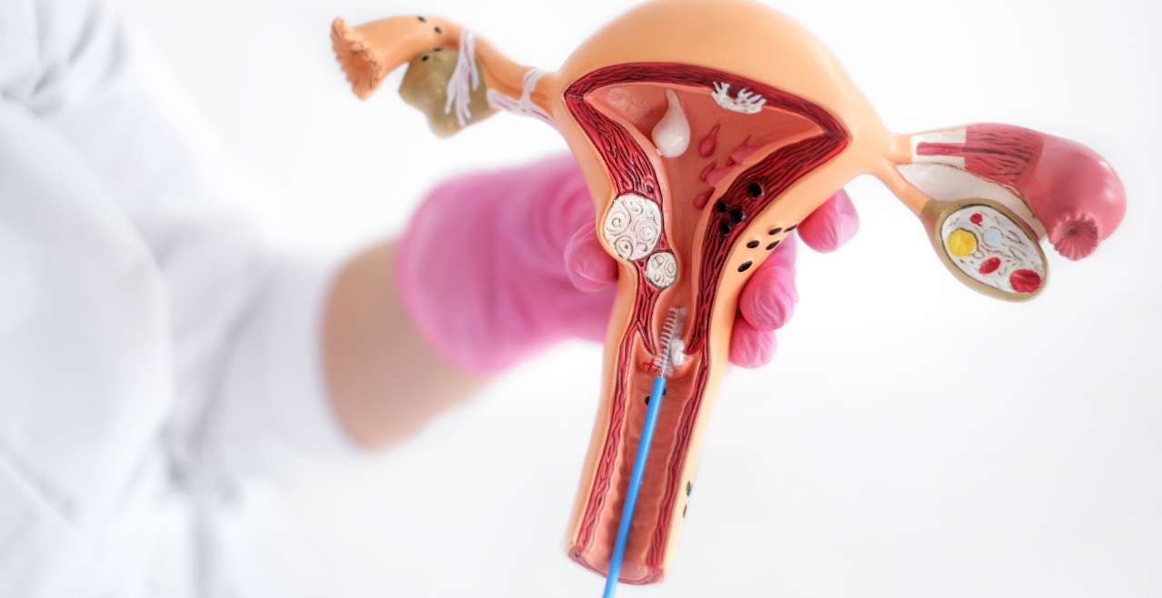 Endometriozis – Adenomyozis